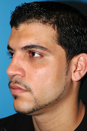 Richard Davis, MD Primary Rhinoplasty: Patient 2, Oblique View, Post-Op