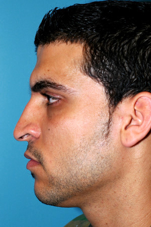 Richard Davis, MD Primary Rhinoplasty: Patient 2, Profile View, Pre-Op