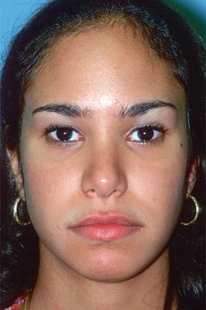 Richard Davis, MD Primary Rhinoplasty: Patient 3, Front View, Post-Op