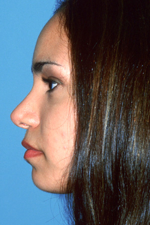 Richard Davis, MD Chin Augmentation: Patient 2, Profile View, Post-Op
