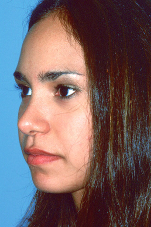 Richard Davis, MD Primary Rhinoplasty: Patient 3, Oblique View, Post-Op