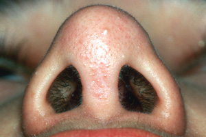 Richard Davis, MD Primary Rhinoplasty: Patient 3, Basal View, Post-Op