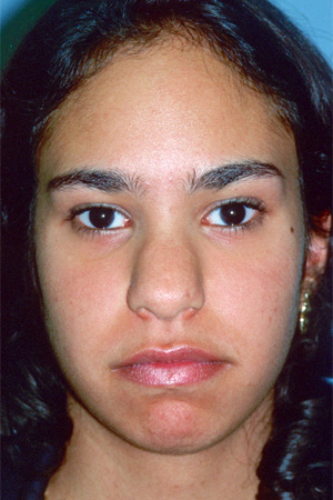 Richard Davis, MD Chin Augmentation: Patient 2, Front View, Pre-Op