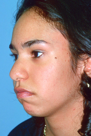 Richard Davis, MD Chin Augmentation: Patient 2, Oblique View, Pre-Op