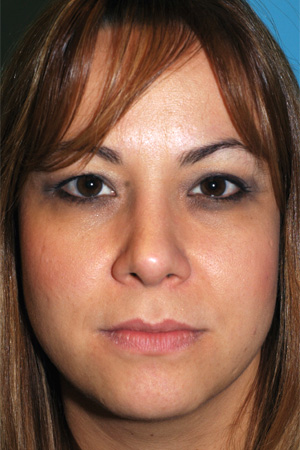 Richard Davis, MD Primary Rhinoplasty: Patient 4, Front View, Post-Op