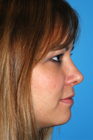 Richard Davis, MD Primary Rhinoplasty: Patient 4, Profile View, Post-Op