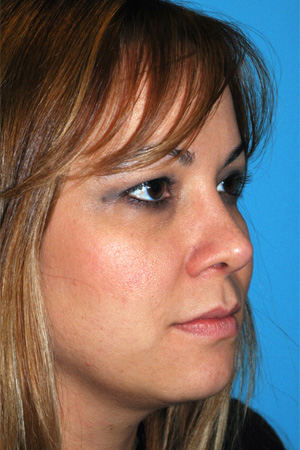 Richard Davis, MD Primary Rhinoplasty: Patient 4, Oblique View, Post-Op