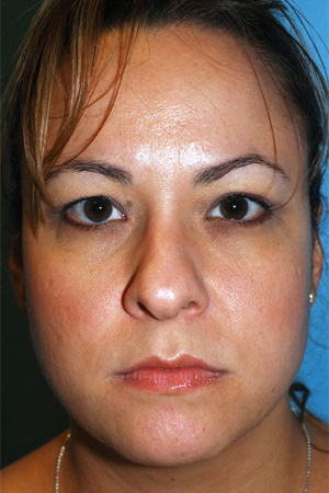 Richard Davis, MD Primary Rhinoplasty: Patient 4, Front View, Pre-Op