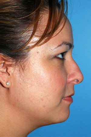 Richard Davis, MD Primary Rhinoplasty: Patient 4, Profile View, Pre-Op