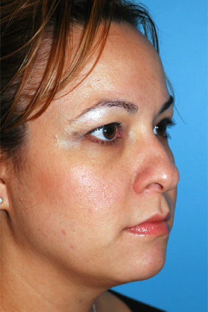 Richard Davis, MD Primary Rhinoplasty: Patient 4, Oblique View, Pre-Op