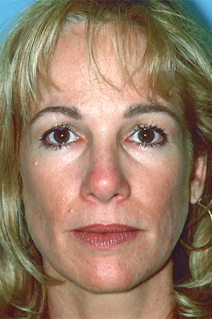 Richard Davis, MD Primary Rhinoplasty: Patient 6, Front View, Post-Op