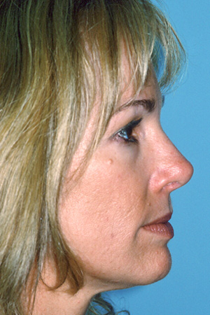 Richard Davis, MD Primary Rhinoplasty: Patient 6, Profile View, Post-Op