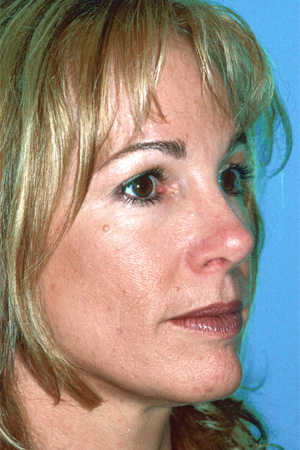 Richard Davis, MD Primary Rhinoplasty: Patient 6, Oblique View, Post-Op