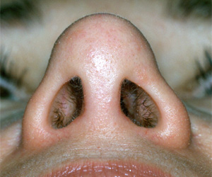 Richard Davis, MD Primary Rhinoplasty: Patient 6, Basal View, Post-Op