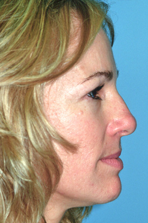 Richard Davis, MD Primary Rhinoplasty: Patient 6, Profile View, Pre-Op