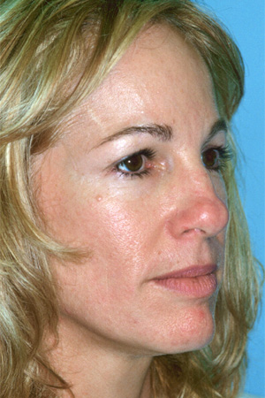 Richard Davis, MD Primary Rhinoplasty: Patient 6, Oblique View, Pre-Op