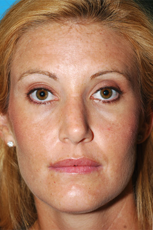 Richard Davis, MD Primary Rhinoplasty: Patient 8, Front View, Post-Op