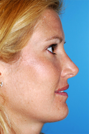 Richard Davis, MD Primary Rhinoplasty: Patient 8, Profile View, Post-Op