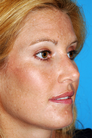 Richard Davis, MD Primary Rhinoplasty: Patient 8, Oblique View, Post-Op