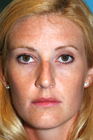 Richard Davis, MD Primary Rhinoplasty: Patient 8, Front View, Pre-Op