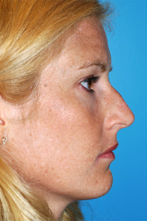 Richard Davis, MD Primary Rhinoplasty: Patient 8, Profile View, Pre-Op