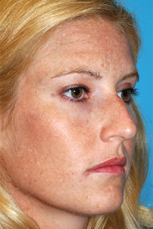 Richard Davis, MD Primary Rhinoplasty: Patient 8, Oblique View, Pre-Op