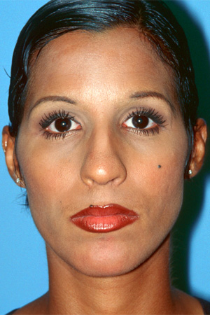 Richard Davis, MD Primary Rhinoplasty: Patient 9, Front View, Pre-Op