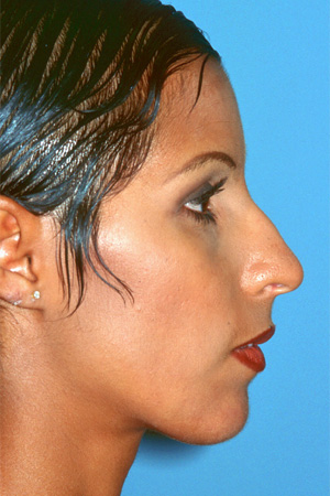 Richard Davis, MD Primary Rhinoplasty: Patient 9, Profile View, Pre-Op