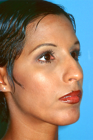 Richard Davis, MD Primary Rhinoplasty: Patient 9, Oblique View, Pre-Op