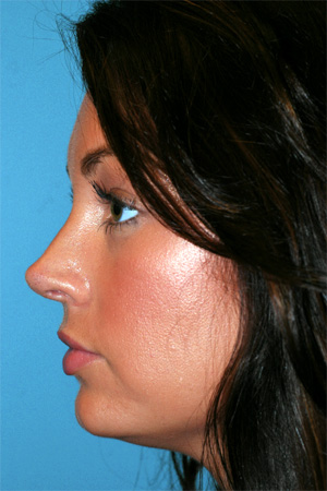 Richard Davis, MD Revision Rhinoplasty: Patient 1, Profile View, Post-Op