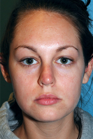 Richard Davis, MD Revision Rhinoplasty: Patient 1, Front View, Pre-Op