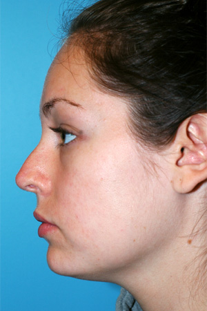 Richard Davis, MD Revision Rhinoplasty: Patient 1, Profile View, Pre-Op