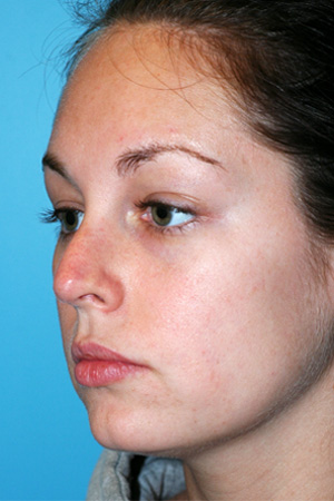 Richard Davis, MD Revision Rhinoplasty: Patient 1, Oblique View, Pre-Op