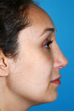 Richard Davis, MD Revision Rhinoplasty: Patient 2, Profile View, Post-Op