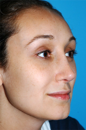 Richard Davis, MD Revision Rhinoplasty: Patient 2, Oblique View, Post-Op