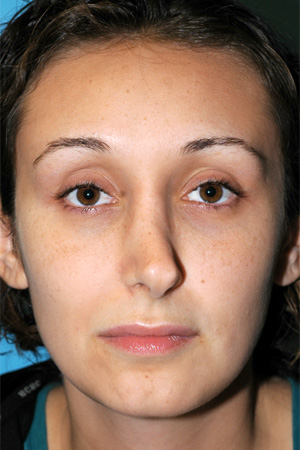 Richard Davis, MD Revision Rhinoplasty: Patient 2, Front View, Pre-Op