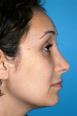 Richard Davis, MD Revision Rhinoplasty: Patient 2, Profile View, Pre-Op