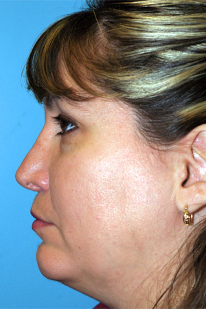 Richard Davis, MD Revision Rhinoplasty: Patient 3, Profile View, Post-Op