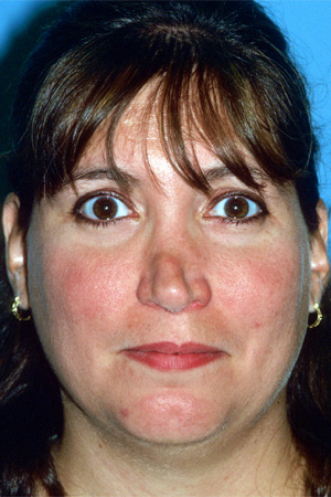 Richard Davis, MD Revision Rhinoplasty: Patient 3, Front View, Pre-Op