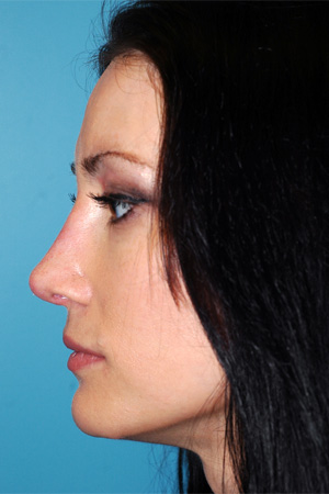 Richard Davis, MD Revision Rhinoplasty: Patient 4, Profile View, Post-Op