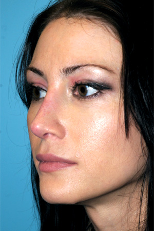 Richard Davis, MD Revision Rhinoplasty: Patient 4, Oblique View, Post-Op