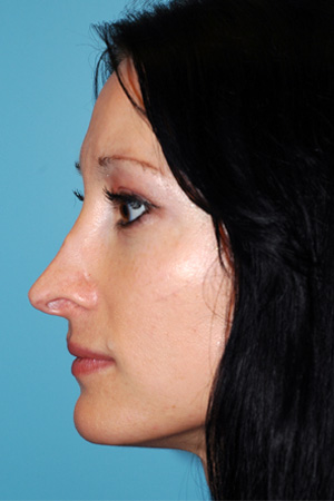 Richard Davis, MD Revision Rhinoplasty: Patient 4, Profile View, Pre-Op