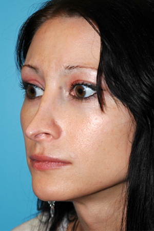 Richard Davis, MD Revision Rhinoplasty: Patient 4, Oblique View, Pre-Op