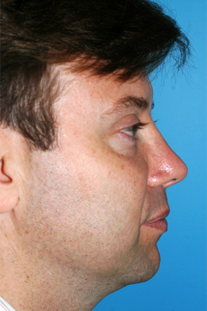 Richard Davis, MD Revision Rhinoplasty: Patient 5, Profile View, Post-Op