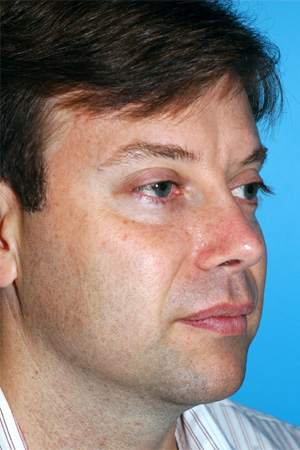 Richard Davis, MD Revision Rhinoplasty: Patient 5, Oblique View, Post-Op