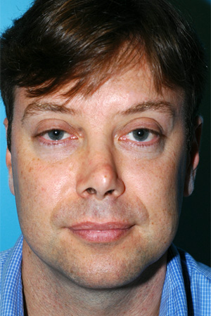 Richard Davis, MD Revision Rhinoplasty: Patient 5, Front View, Pre-Op