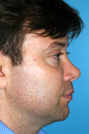 Richard Davis, MD Revision Rhinoplasty: Patient 5, Profile View, Pre-Op