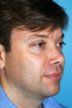 Richard Davis, MD Revision Rhinoplasty: Patient 5, Oblique View, Pre-Op