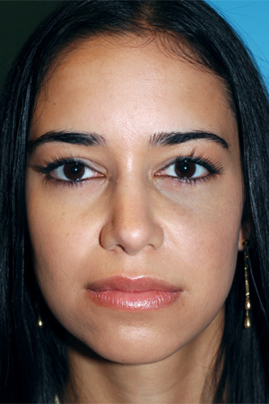 Richard Davis, MD Revision Rhinoplasty: Patient 6, Front View, Post-Op