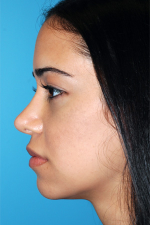 Richard Davis, MD Revision Rhinoplasty: Patient 6, Profile View, Post-Op